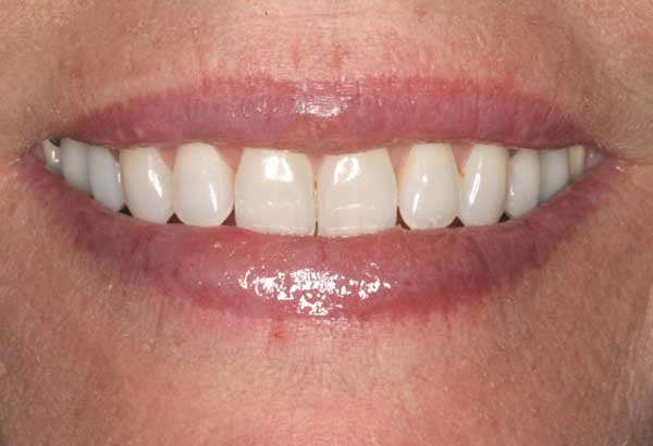 teeth-whitening-after