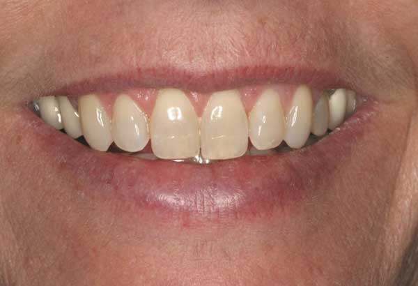 teeth-whitening-after