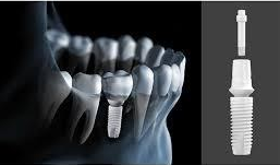 zirconia